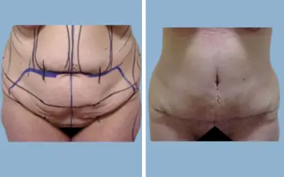 Before and After